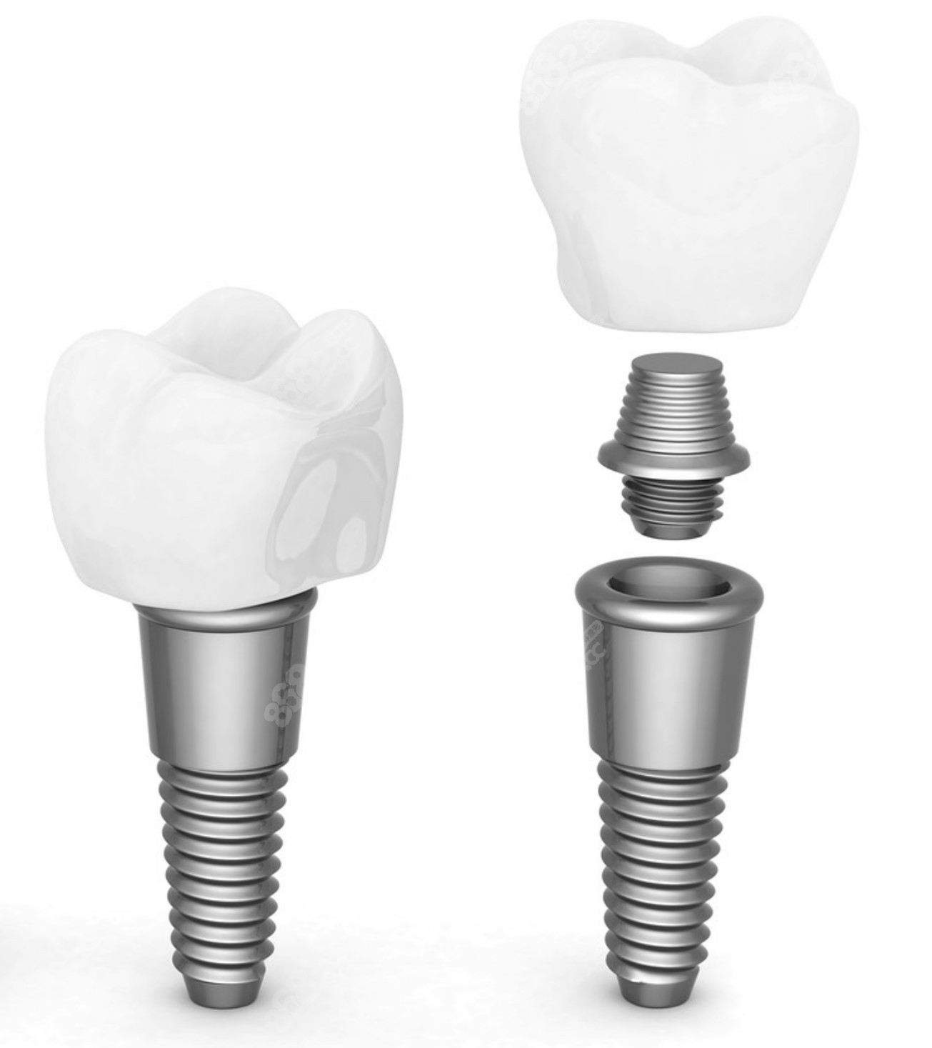 延吉種植牙 延吉種植牙