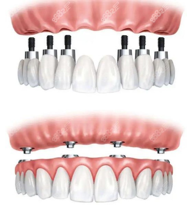 全口种植牙多少钱