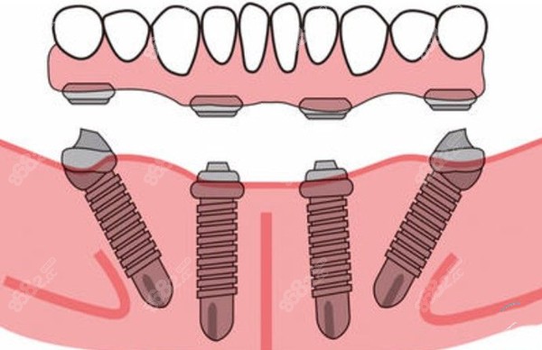 從化區(qū)全口種植牙費用一覽