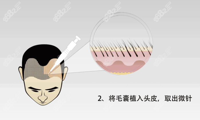 苏州大麦微针植发技术价格
