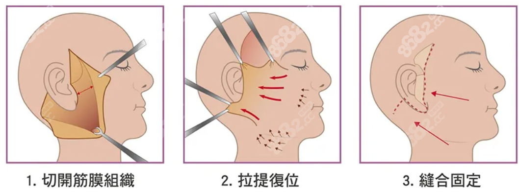 小拉皮手术切口图片