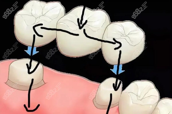 深圳镶牙哪个医院好?