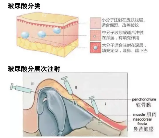 新疆玻尿酸注射隆鼻