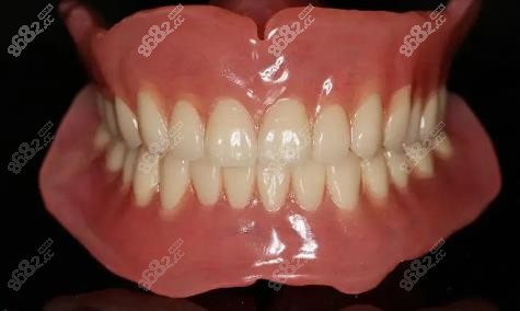 bps吸附性义齿为什么贵? bps吸附性义齿为什么贵?