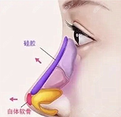 新疆做综合隆鼻价格