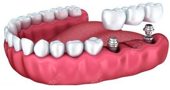 從化區(qū)做種植牙的價格
