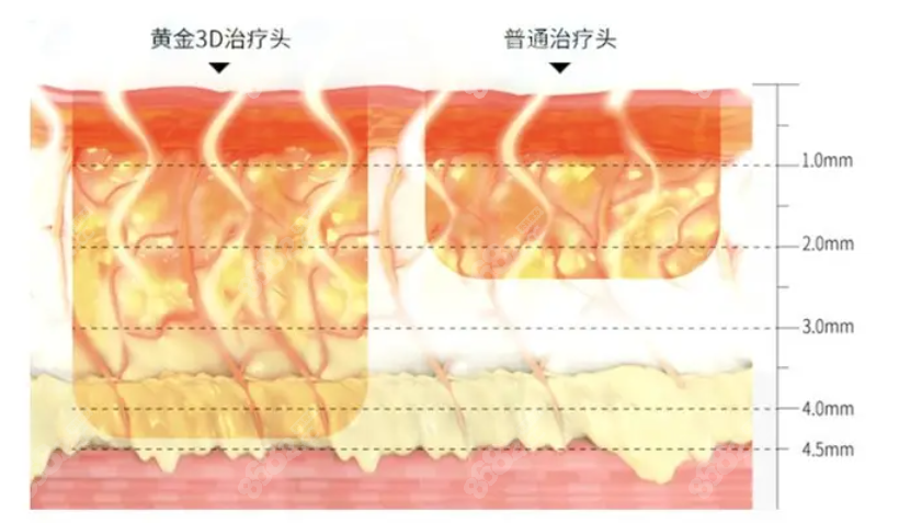 热玛吉四代的1200发黄金探头