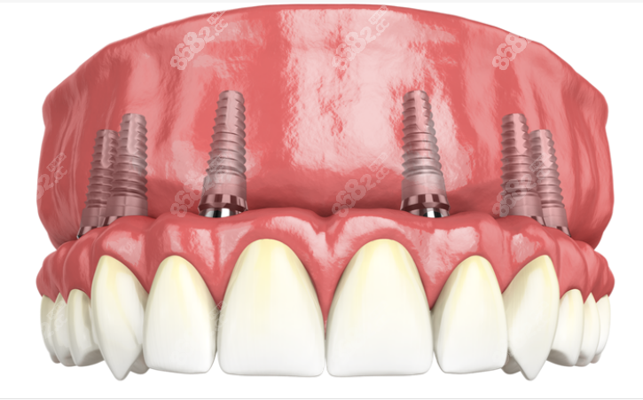 全口种植牙的价格
