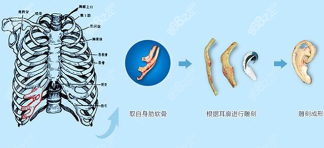 自体肋骨耳再造手术过程