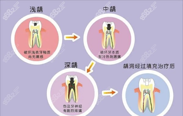 牙齿的不同龋坏程度