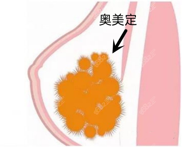 胸部奥美定取出切口