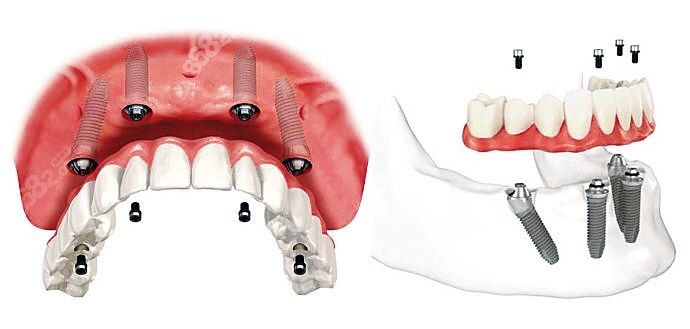 北京顺德口腔半全口种植牙价格