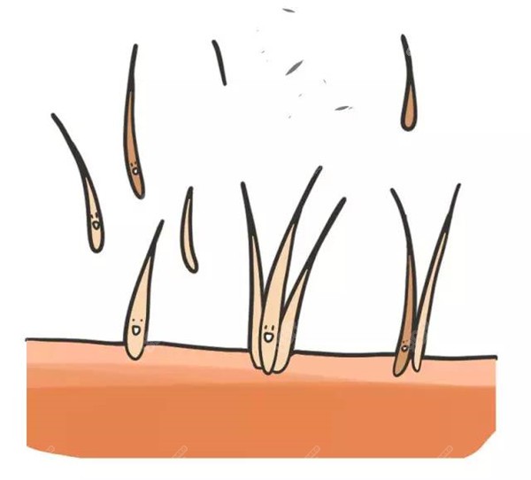 毛囊移植