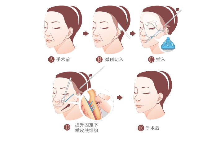 小切口拉皮手术除皱过程