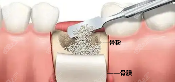 种植牙骨粉和骨膜在什么情况下用