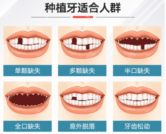 种植牙适合人群