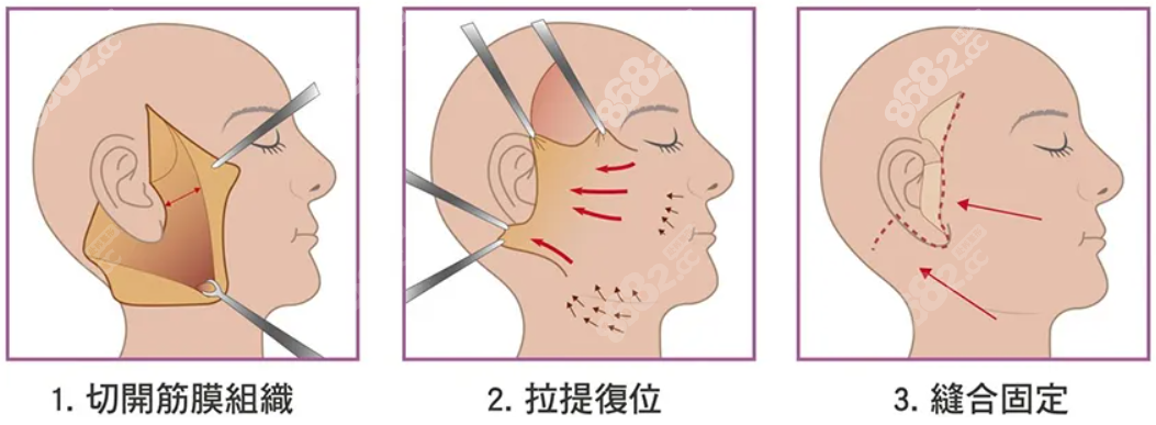 拉皮手术过程图示