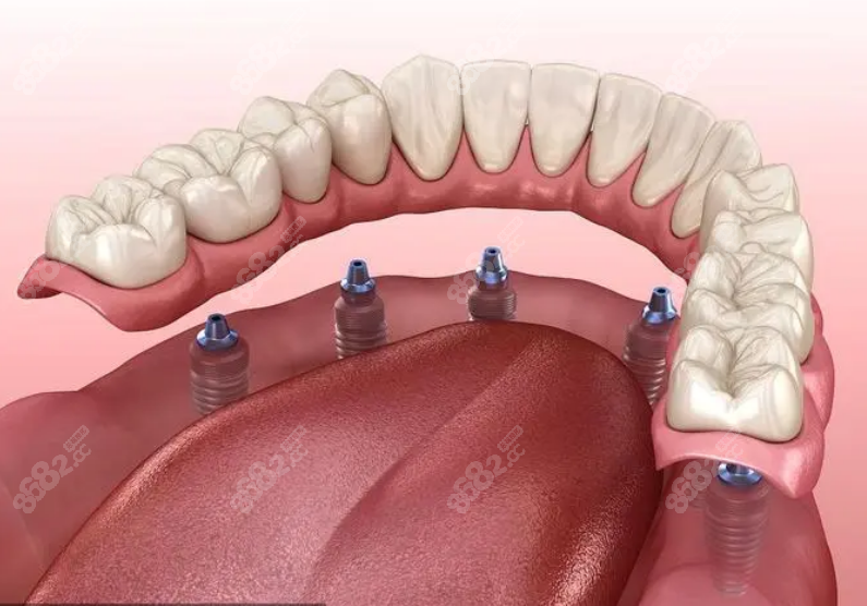 全口种植牙价格表