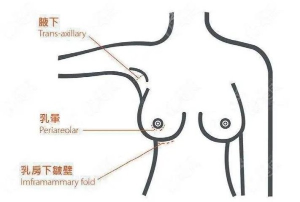 胸部奥美定取出可以选择的切口位置