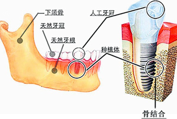 种植牙在牙槽骨内的图