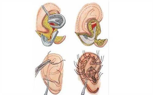 耳再造手术操作图解