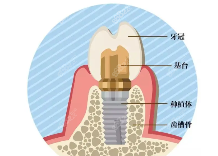 三四千的种植牙不一定可靠