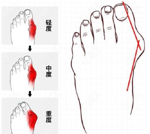 国内微创治疗拇外翻好的医院排名