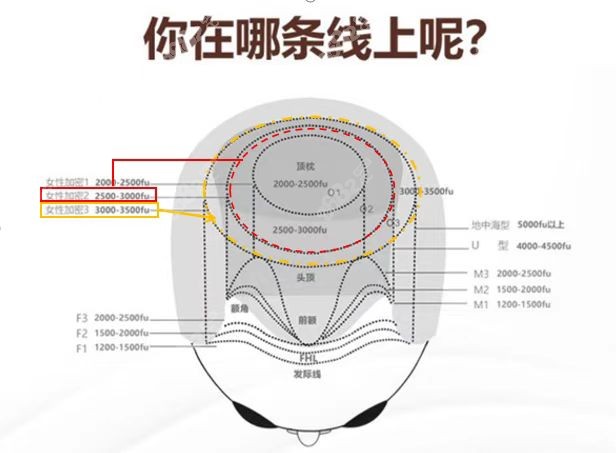 男士植发数量预估示意图