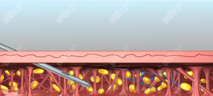 超脂塑吸脂原理示意图参考