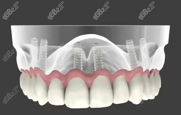 allon6种植牙模拟