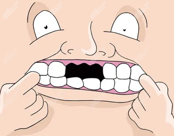 益阳奥齿泰种植牙价格 益阳奥齿泰种植牙价格