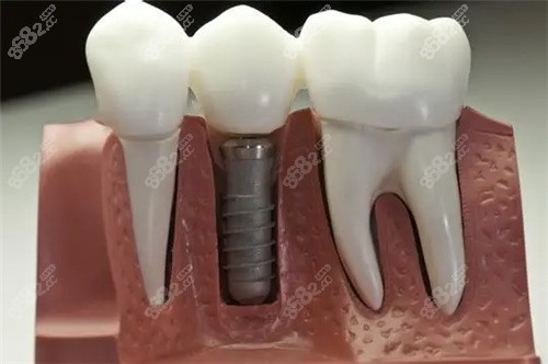 珠海仁爱口腔种植牙挺靠谱