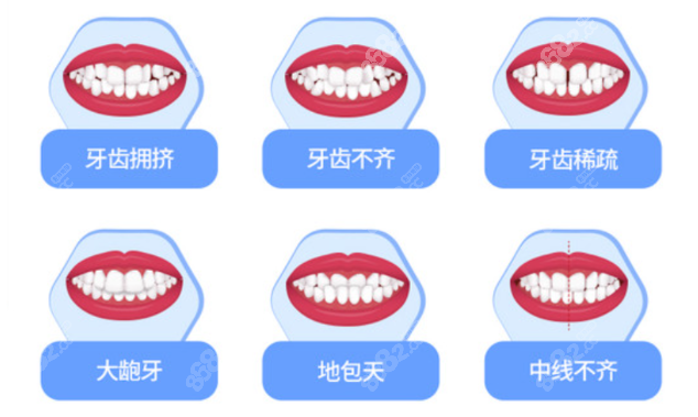 宁波隐适美隐形牙套价格表