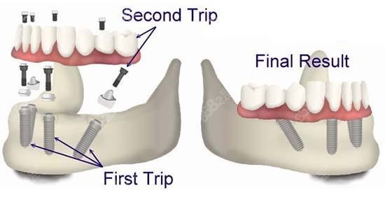 allon4种植牙示意图