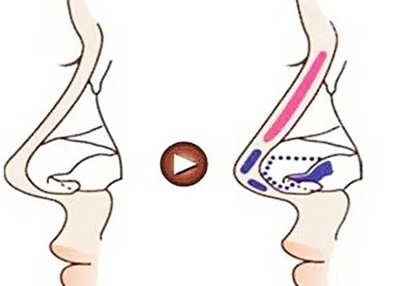 耳软骨隆鼻后出现鼻头回缩