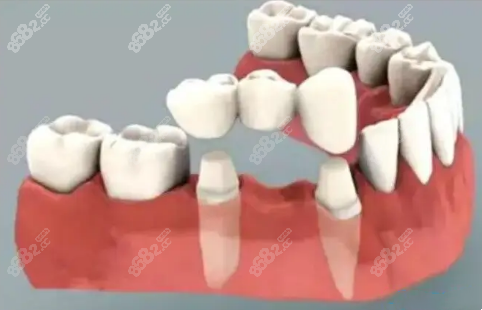 四颗门牙缺失的修复方案