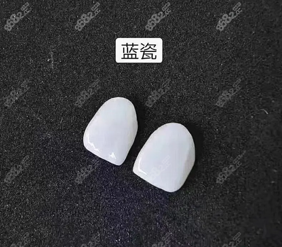 蓝瓷牙齿贴面图