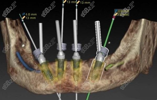 数字化allon4种植牙设计