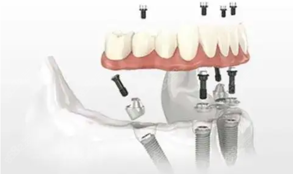 益阳做半口种植牙多少钱 益阳做半口种植牙多少钱