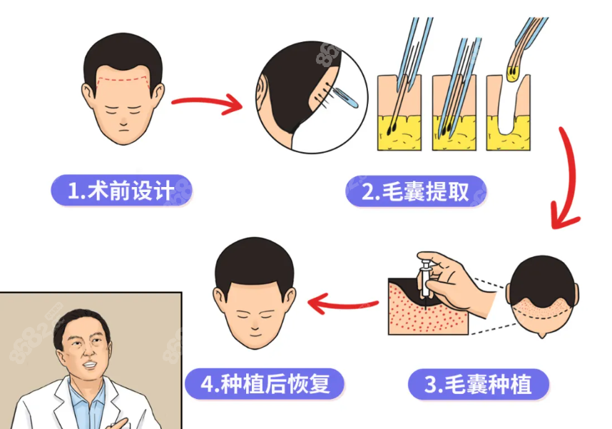 男士植发流程