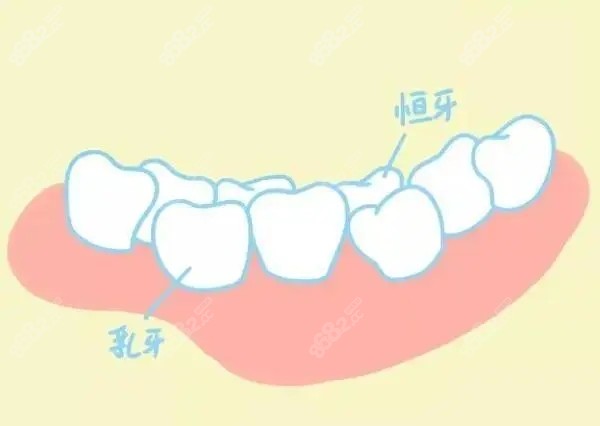 小孩牙齿出现双排牙的排列情况