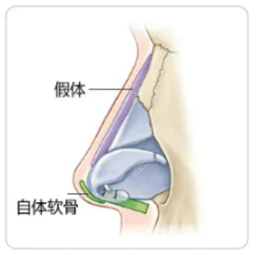 王天成医生做鼻子