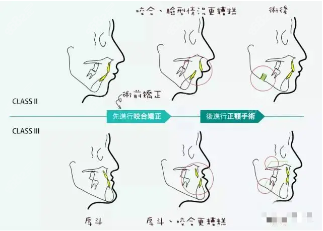 中/重度骨性凸嘴上下正颌手术费用