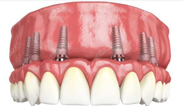 衡阳半口种植牙价格