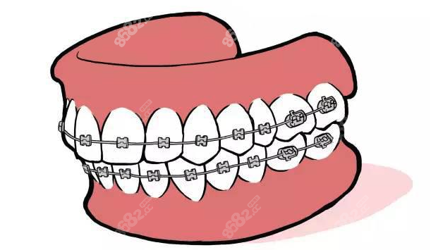 深覆合牙齿矫正一定要佩戴牙套吗