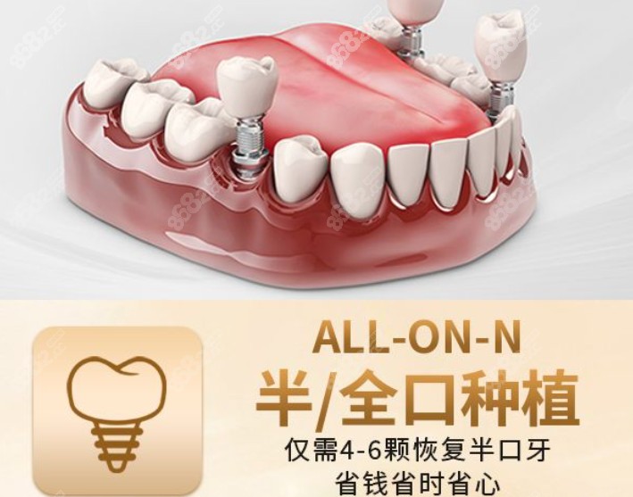 Allon4/6种植牙技术