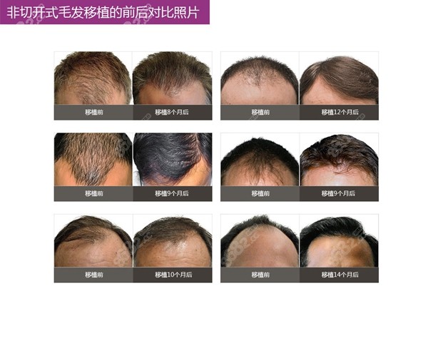 center9_catogory03_hair_transplant_04.jpg