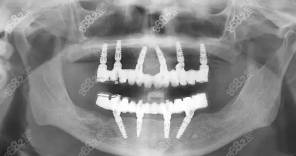 衡阳全口种植牙价格