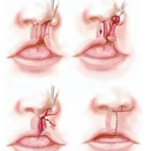 唇腭裂修复手术过程