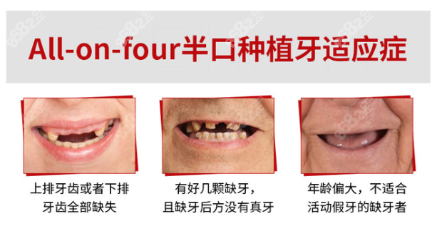 乐清半口种植牙价格表